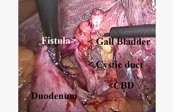 Cholecystoduodenal-fistula1