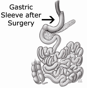 Gastric-Sleeve-2-2