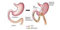 Intraoperative colonoscopy for Large benign submucosal lipoma presented with ascending colon 