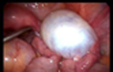 Ovarian Cysts Removal