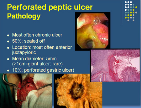 Peptic-ulcer2