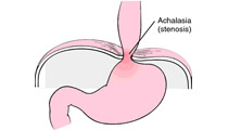 achalasia surgery