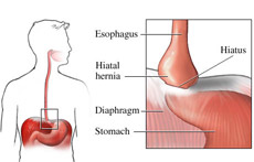 Esophageal Hernia