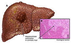 Liver and Bile Duct Cancer Surgery
