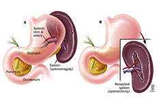 Splenectomy
