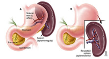 splenectomy
