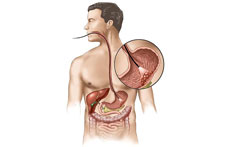 Stomach Cancer Surgery