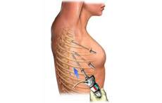 قطع عصب سمپاتیک گردنی – سینه‌ای جهت درمان تعریق شدید دست‌ها