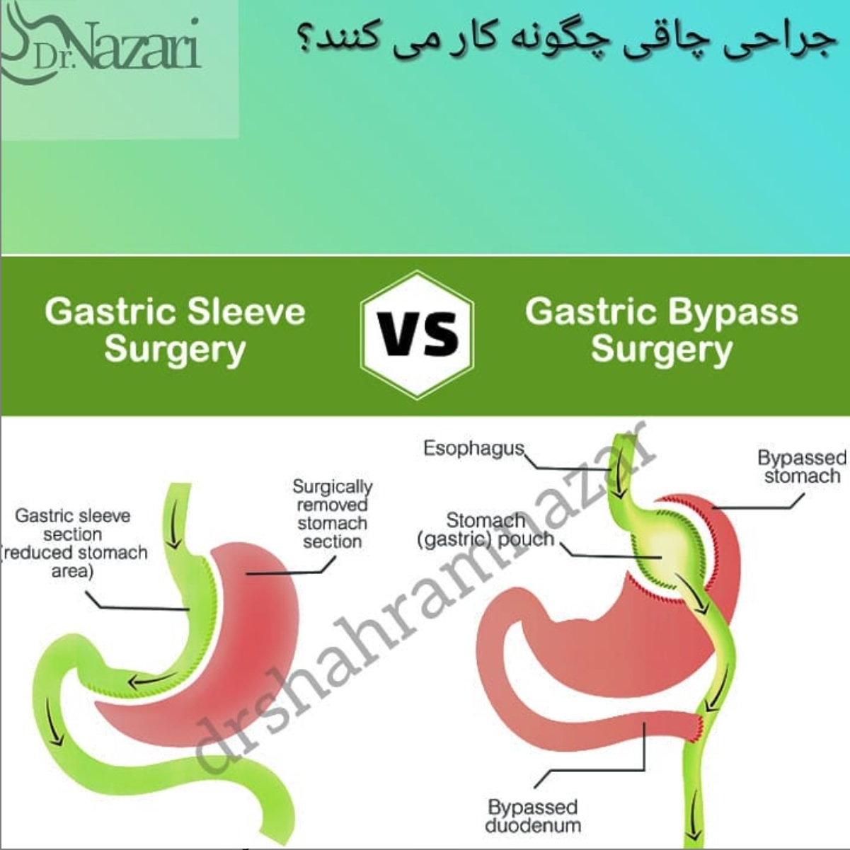 Bypass surgery new bowel direction